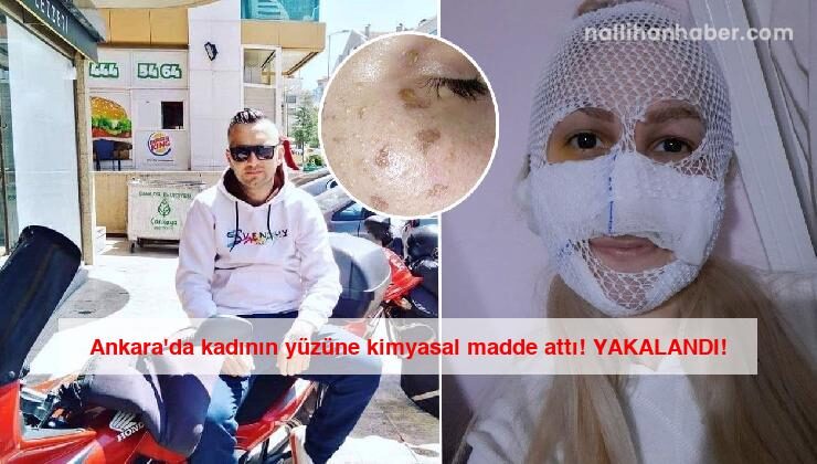 Ankara’da kadının yüzüne kimyasal madde attı! YAKALANDI!